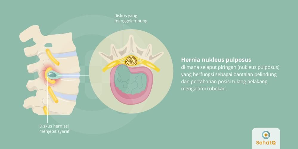 HERNIA NUKLEUS PULPOSUS