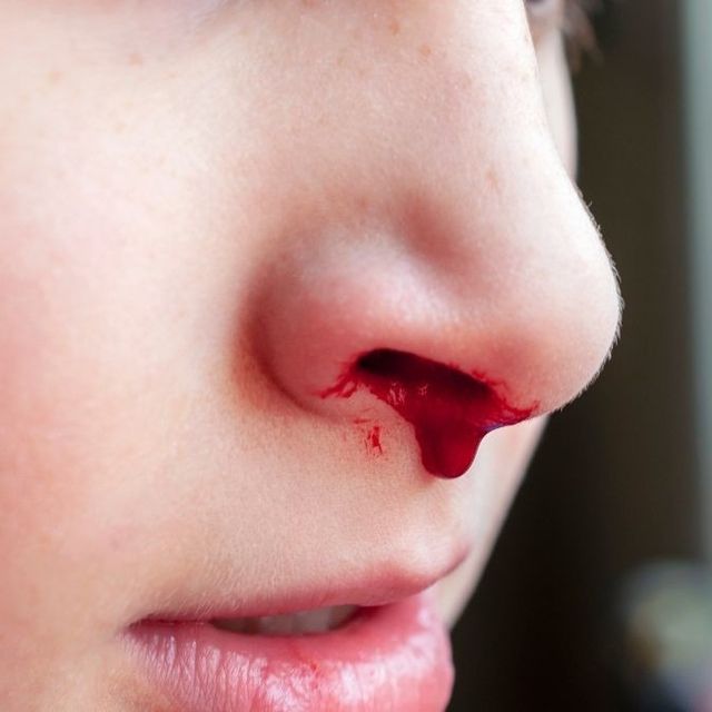 Banyak Yang Mengatakan Bahwa Daun Sirih Bisa Membantu Mengatasi Mimisan